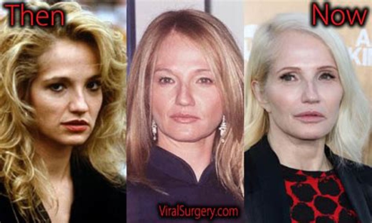 Ellen Barkin Plastic Surgery Nose Job Before
