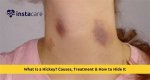 Tiktokers Say They Can Reduce Their Hickeys with a Kitchen Whisk. Doctors Explain Why It May Work, A